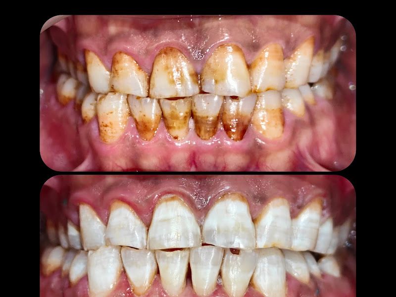 Gallery — Punamiya Dental Clinic l Dr. Ankit & Dr. Paryusha l Best Dental Clinic in PCMC l Dentist in Akurdi l Root Canal Specialist, Akurdi