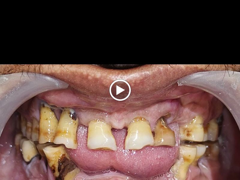 Gallery — Punamiya Dental Clinic l Dr. Ankit & Dr. Paryusha l Best Dental Clinic in PCMC l Dentist in Akurdi l Root Canal Specialist, Akurdi