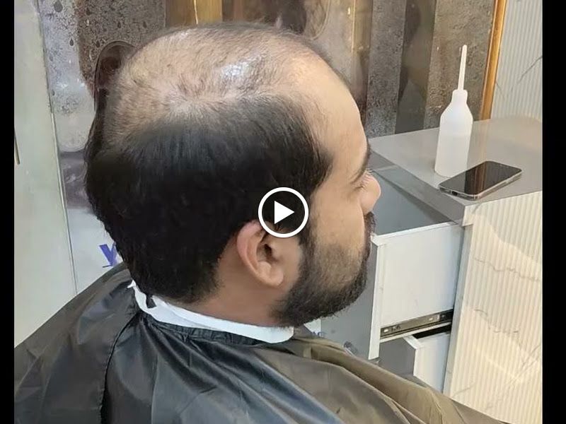 Gallery — Golden Hair Fixing, Kalyan