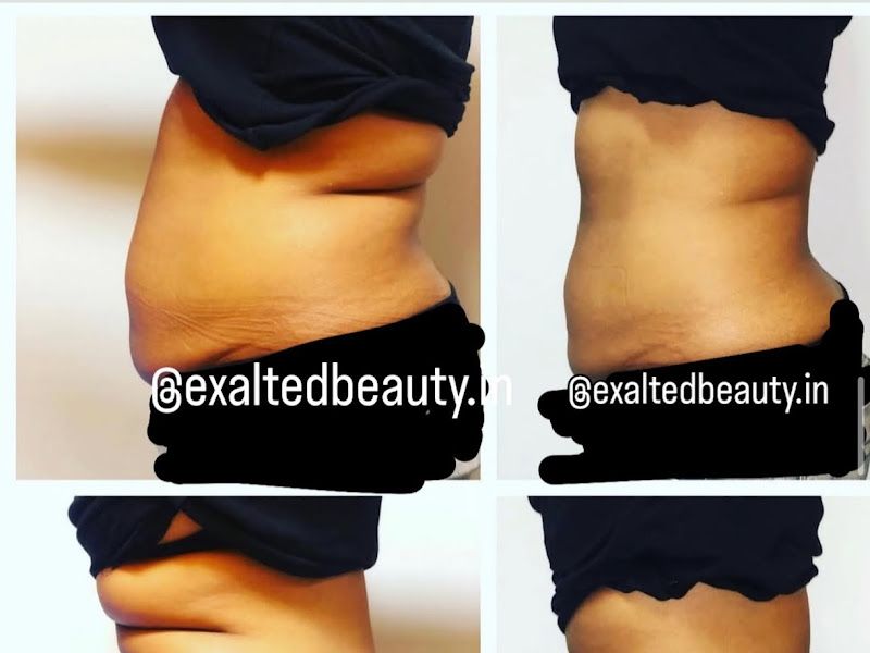 Owner-shared before & after — tummy and back-fat reduction across a body-contouring / fat-loss course, shown in side profile. — Exalted Beauty, Versova, Mumbai