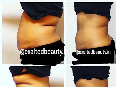 Exalted Beauty — Skin Care Clinic in Versova, Mumbai