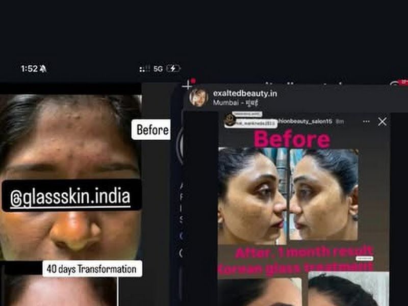 Owner-shared before & after — a 40-day glass-skin and pigmentation-brightening transformation. — Exalted Beauty, Versova, Mumbai
