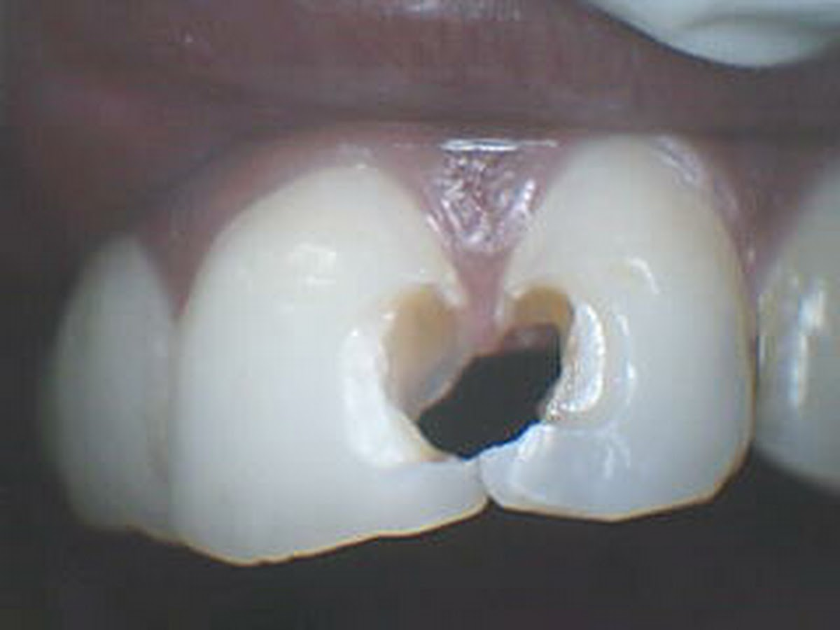 Clear aligner fitting at HAPPY TEETH by Dr. Priyank Bajani