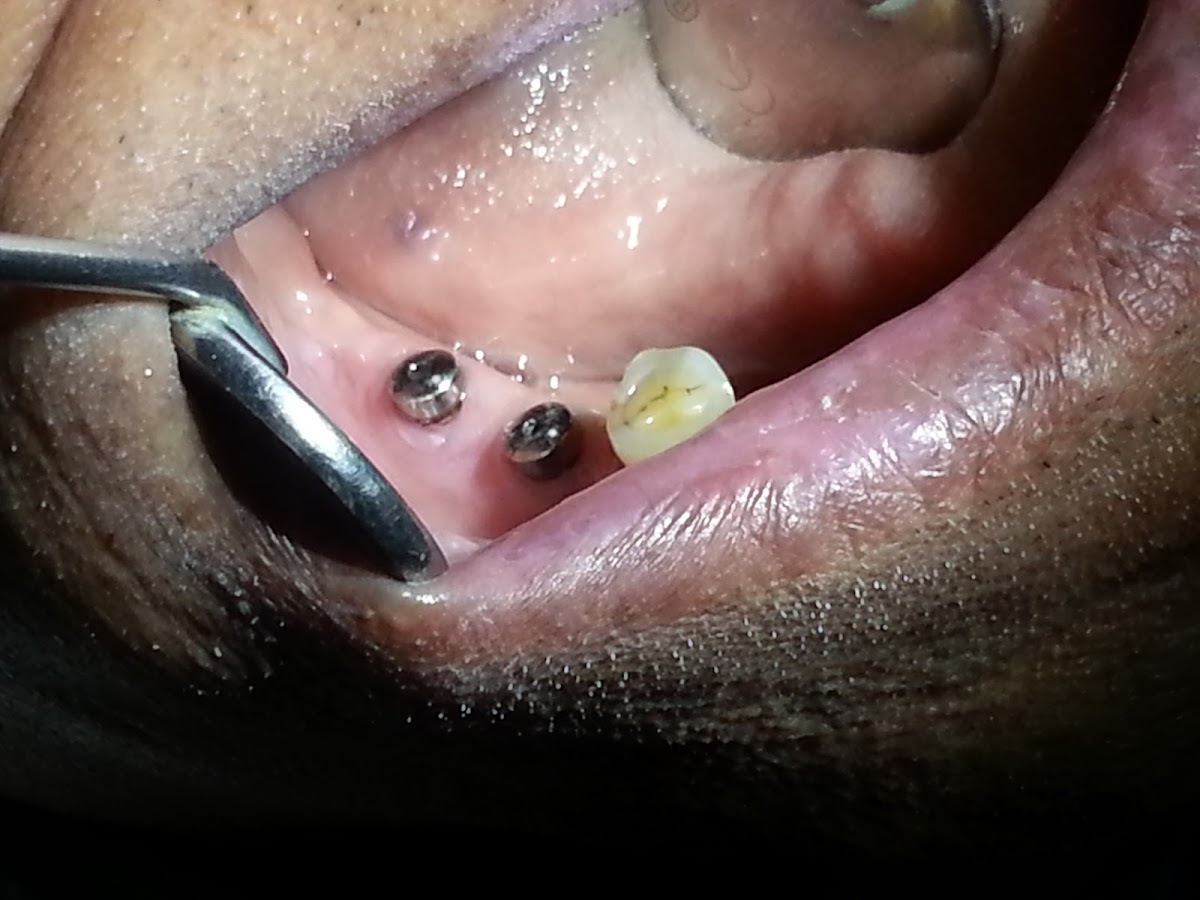 Dr. Priyank Bajani treating a patient at HAPPY TEETH