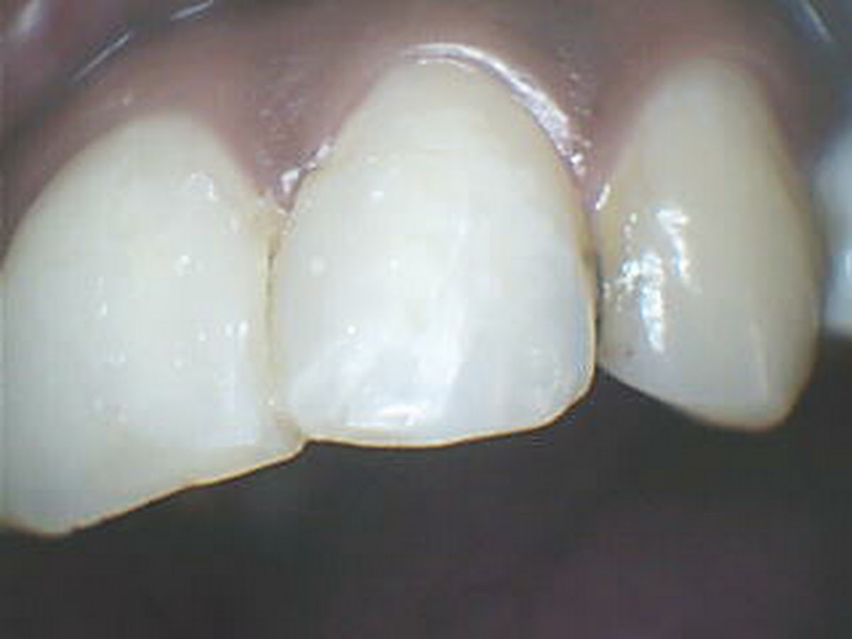 Intraoral scanning during a treatment at HAPPY TEETH