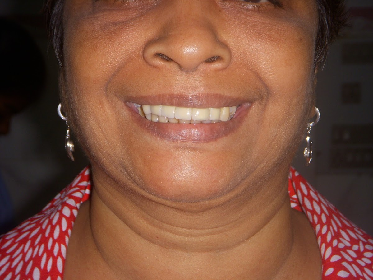 Dental implant procedure at HAPPY TEETH by Dr. Priyank Bajani
